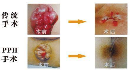 福州肛乳头瘤会痒吗?